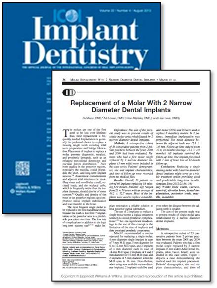 Remplazo de molares con 2 implantes dentales de diámetro estrecho